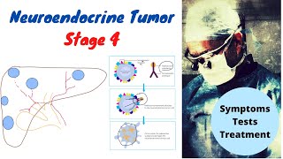 Neuroendocrine Tumor Stage 4 Symptoms Tests Treatment [upl. by Nosral]