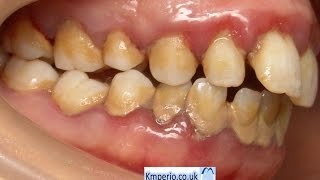 Treatment of Periodontal DiseaseBefore and After [upl. by Warden]