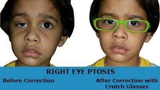 ocular myasthenia gravis treatment in hindi [upl. by Chura]