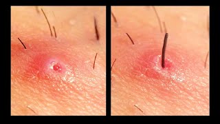 Ingrown hair removal [upl. by Kieran]