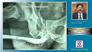 Lecture 7 Male urethrography  Complications [upl. by Anekahs]