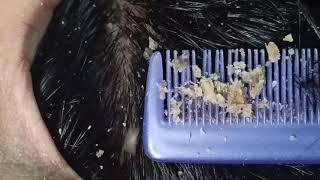 Dandruff Removal Scratching Satisfying Flakes [upl. by Alodi956]