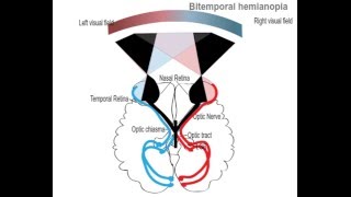 Bitemporal hemianopia [upl. by Horodko]