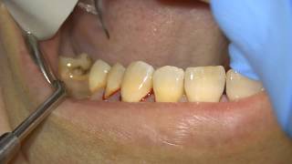 Scaling  Root Surface Debridement with Airpolishing [upl. by Intyrb]