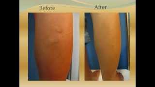 Varicose Veins for Sclerotherapy 靜脈曲張注射治療 Before and After Treament [upl. by Airdnas]