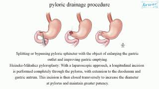 pyloric drainage procedure [upl. by Ahmar272]