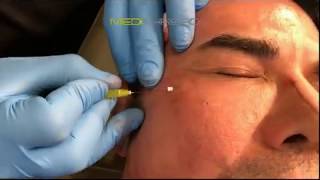 PDOTHREAD LIFT PROCEDURE BY MEDiTHREAD  Eyes [upl. by Muna]