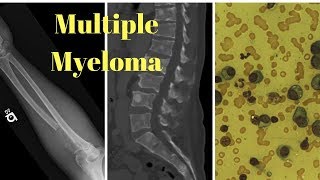 Outlook for People with Multiple Myeloma [upl. by Clarine]