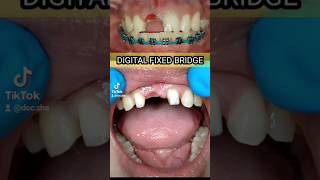 REPLACING PORCELAIN FUSED TO METAL MARYLAND BRIDGE TO DIGITAL PMMA BRIDGE dentaltips denture [upl. by Rebm607]