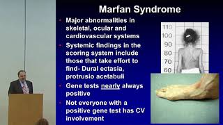 Management of the Pediatric Patient with Marfan Syndrome [upl. by Assil]