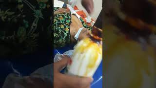 Permanent Catheter Removal Part 1 video by Dr Omar Nephrologist [upl. by Nahama]