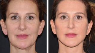 Best Facelift Surgeon in NY Before amp After Compilation [upl. by Deonne]