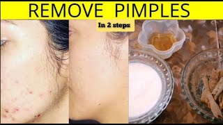 2 Simple Steps To Remove Pimples  How To Get A Rid Of Pimples [upl. by Worlock816]