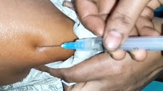 Arms im injection pushIntramuscular Ketorolac 30mg injection video24 Ep97 by LaFiN injection push [upl. by Edyaw417]