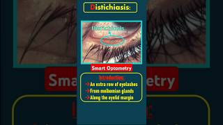 Distichiasis eyes optometry optometrist optometrists eyediseases distichiasis eyelid eyes [upl. by Ratna]