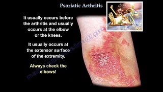 Psoriatic Arthritis  Everything You Need To Know  Dr Nabil Ebraheim [upl. by Kilmarx466]