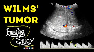 Wilms Tumor  Ultrasound  Case 47 [upl. by Danyelle394]