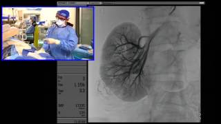 Transradial BalloonAssisted Onyx Embolization of Renal Angiomyolipoma [upl. by Ariella]