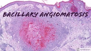 Bacillary Angiomatosis Dermatopathology Pearls [upl. by Narot600]