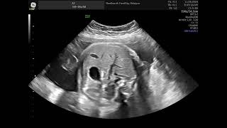 Fetal Breathing Respiratory movements Biophysical profile [upl. by Dorr541]