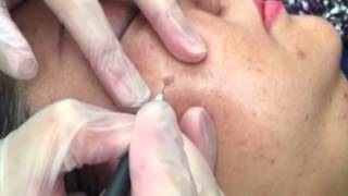 Clinical Skin Clear  age spot removal [upl. by Htezzil]