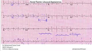 Atrial flutter or fibrillation that is the question [upl. by Atiuqrahs]