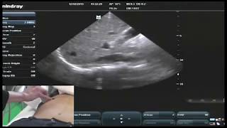 Hot Tips  IVC Volume Assessment with Ultrasound [upl. by Mychael]