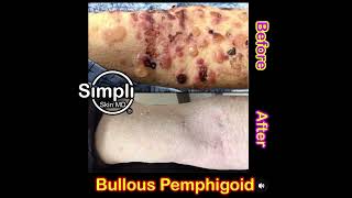 Bullous Pemphigoid Before and After [upl. by Nevi991]