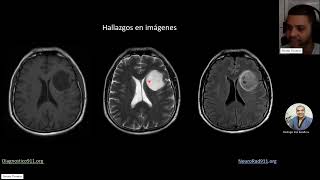 Caso Glioma IDH mutante Astrocitoma G2 [upl. by Burke]