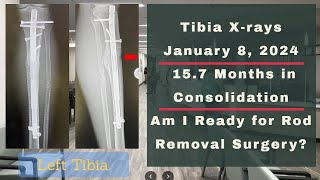 Height Journey  Tibia Xrays 157 Months In Consolidation  January 8 2024 [upl. by Violetta]