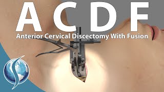 Anterior Cervical Discectomy and Fusion [upl. by Anairdna]