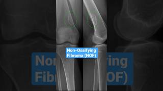 NonOssifying Fibroma bones radiology knee [upl. by Haukom]