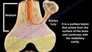 Osteochondroma  solitary and multiple  Everything You Need To Know  Dr Nabil Ebraheim [upl. by Eidroj]