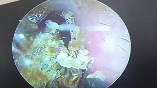 Processing fungal thick dry patches on the eardrum earwax Cleaning earwaxremoval doctoranh [upl. by Kulda189]