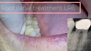 Root Canal Treatment 46 Crown Removal 4K OXO CAMERA [upl. by Dominic]