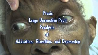 Isolated CN III Palsy [upl. by Eciuqram]