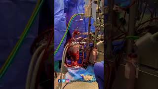 Perfusion aspects by a clinical Perfusionist perfusion nurse [upl. by Grose]