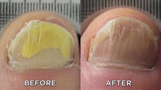 Nail Fungus Zap It with New Laser Treatment [upl. by Airdnola]