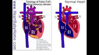 41 Tetralogy of Fallot withOUT pulmonary stenosis [upl. by Radu]