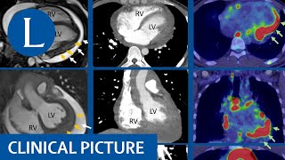 Differentiating tuberculosis from sarcoid using multimodal investigations [upl. by Ativoj]