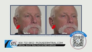 Smooth out your fine lines with Plexaderm for only 1495 [upl. by Bourke464]