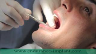 refaire toutes ses dents implant dentaire [upl. by Winthrop]