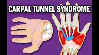 CARPAL TUNNEL SYNDROME [upl. by Ajup384]