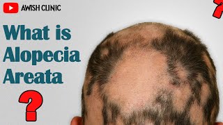 Alopecia Areata क्या है Alopecia का इलाज [upl. by Nipahc]