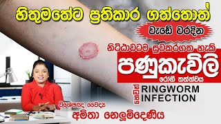 පණුකැවිලි රෝගය හෙවත් Ringworm infection සදහා ප්‍රතිකාර  Skin Specialist [upl. by Aivitnahs]