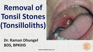 Tonsil Stone Removal  Tonsillolith removal by Dr Raman Dhungel [upl. by Celestyna501]