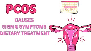 Polycystic Ovary Syndrome  PCOS  Causes  Sign  Symptoms amp Dietary Treatment [upl. by Zellner]