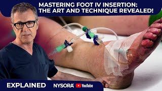 Mastering IV Insertion in the Foot Key Techniques for Success [upl. by Orrocos]