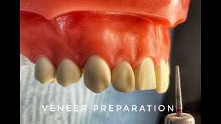 Veneer Preparation [upl. by Kaine]