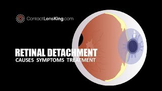 Retinal Detachment Causes Symptoms and Treatments [upl. by Barling]